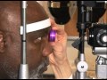 National Eye Institute Glaucoma