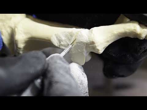 MINIMALLY INVASIVE CORRECTION OF ARTHRITIS OF 1ST BIG TOE JOINT