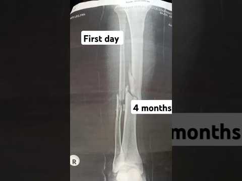 Bone fracture healing process