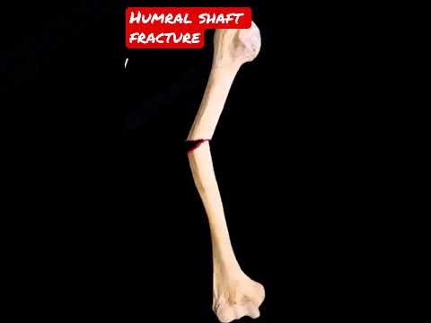 Humeral shaft fracture #shorts