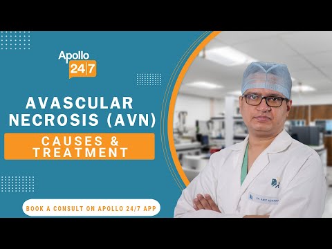 How to Get Rid of Warts Masse Dr Srabani Ghosh Zoha