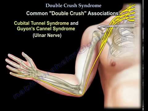 Double Crush Syndrome - Everything You Need To Know - Dr. Nabil Ebraheim