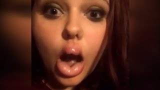 Teens Suffer Crazy Injuries Attempting 'Kylie Jenner Lip Challenge'