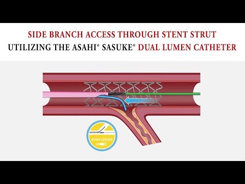 Side Branch Access through Stent Strut: Dual Lumen Technique