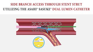 Side Branch Access through Stent Strut: Dual Lumen Technique