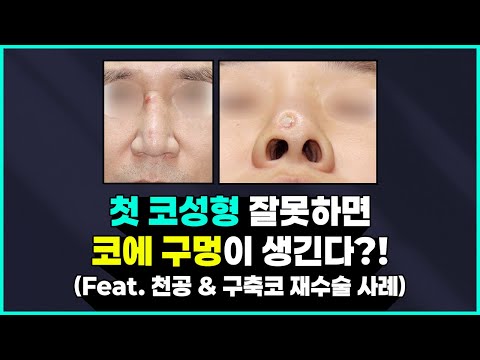 첫 코 성형 잘못하면 이런 부작용까지도 찾아옵니다... ⚠ (Feat. 천공, 구축코)