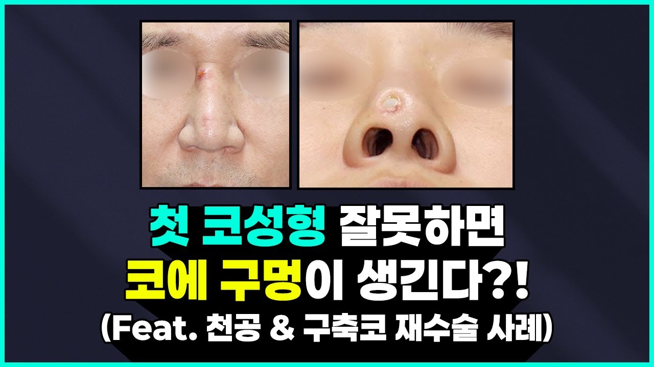 첫 코 성형 잘못하면 이런 부작용까지도 찾아옵니다... ⚠ (Feat. 천공, 구축코) 썸네일