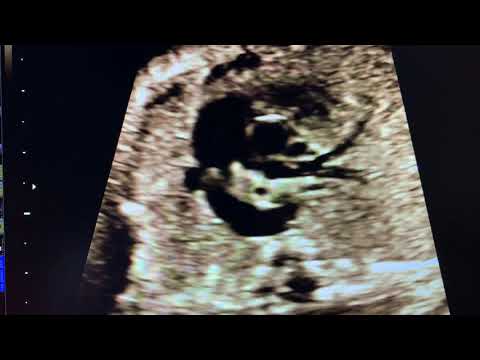 Persistent Left SVC by Dr Nitin Potdar