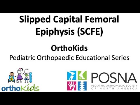Slipped Capital Femoral Epiphysis (SCFE) in Kids