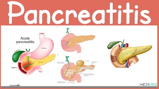 Acute and Chronic Pancreatitis: Pathophysiology, Presentation, Diagnosis and Management Made easy