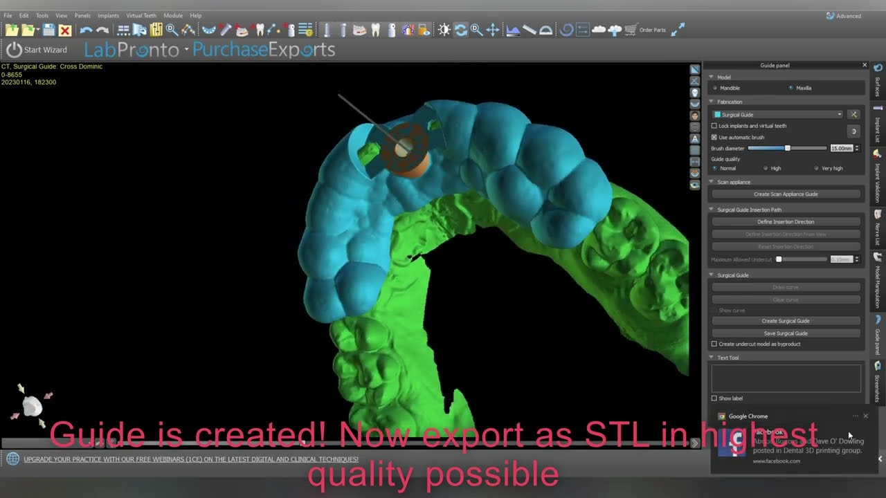 Blue Sky Plan digital extraction and surgical guide design