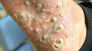 There Are Many Warts On The Soles Of The Feet, Carefully Treat And Trim【Xue Yidao】