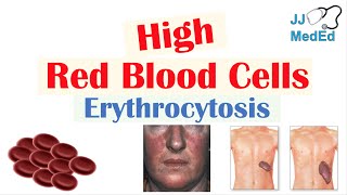 High Red Blood Cells (Erythrocytosis) | Causes, Signs and Symptoms, and Treatment