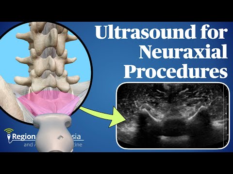 Ultrasound for Neuraxial Procedures