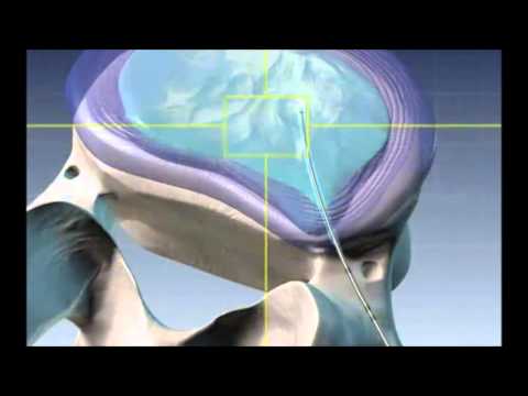 Peggioramento circolazione cerebrale della malattia degenerativa del disco cervicale Esercizi per le articolazioni della gamba