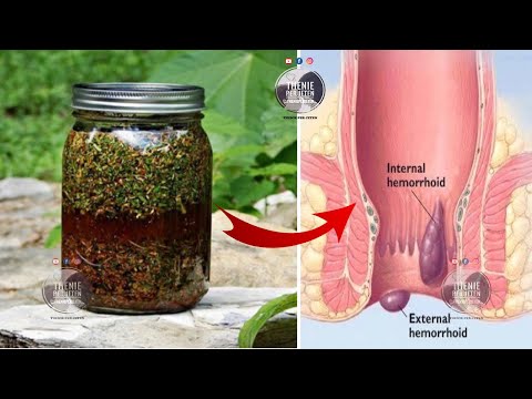 Si te shpëtoni nga hemorroidet një herë e përgjithmonë me kete recetë
