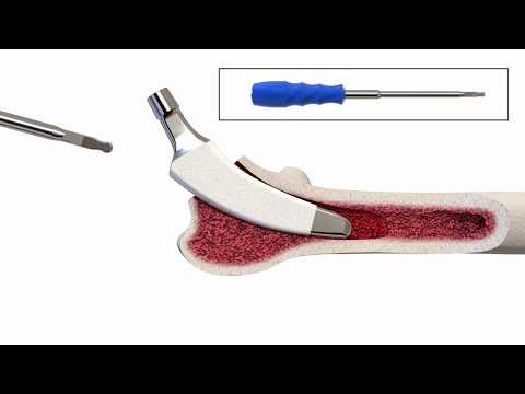 Individual reconstruction