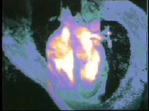 Инфаркт что это такое и последствия Инфаркт что это такое и последствия