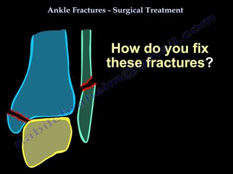 Ankle Fracture Surgical Treatment