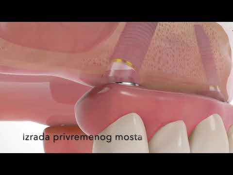 All on 4 treatment concept -  Dental Practice Dentalux