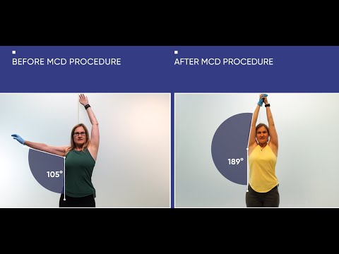 Nurse’s Frozen Shoulder Gone in 2 Days | No More Sleepless Nights