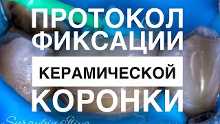 Фиксация керамической коронки на зуб , мой протокол фиксации коронки на зуб , керамическая коронка