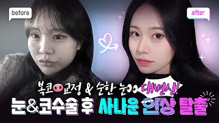 눈, 코 재수술 후기 Vlog ㅣ 하이코 재수술, 사나운 인상 개선