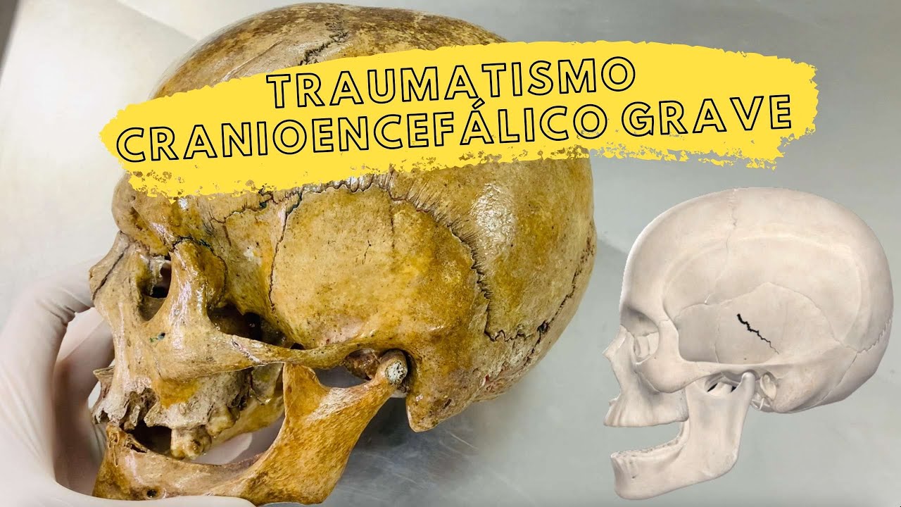 Caso clínico: Traumatismo cranioencefálico grave