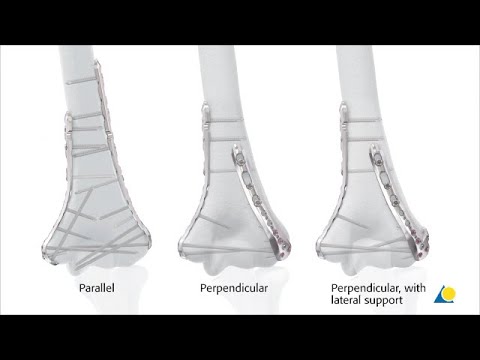 Humerus, Distal - Fracture 13C3 - Fixation with VA-LCP Distal Humerus Plates —Perpendicular Plating