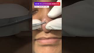 Nose blackheads removal at skinaa clinic | Viral #shorts