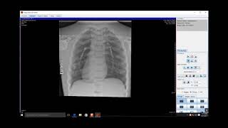 View Patient CD in ImageSuite