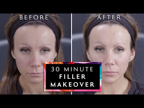 How Dermal Fillers Can Be Used All Over The Face