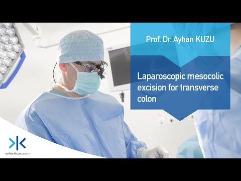 Laparoscopic Mesocolic Excision for Transverse Colon