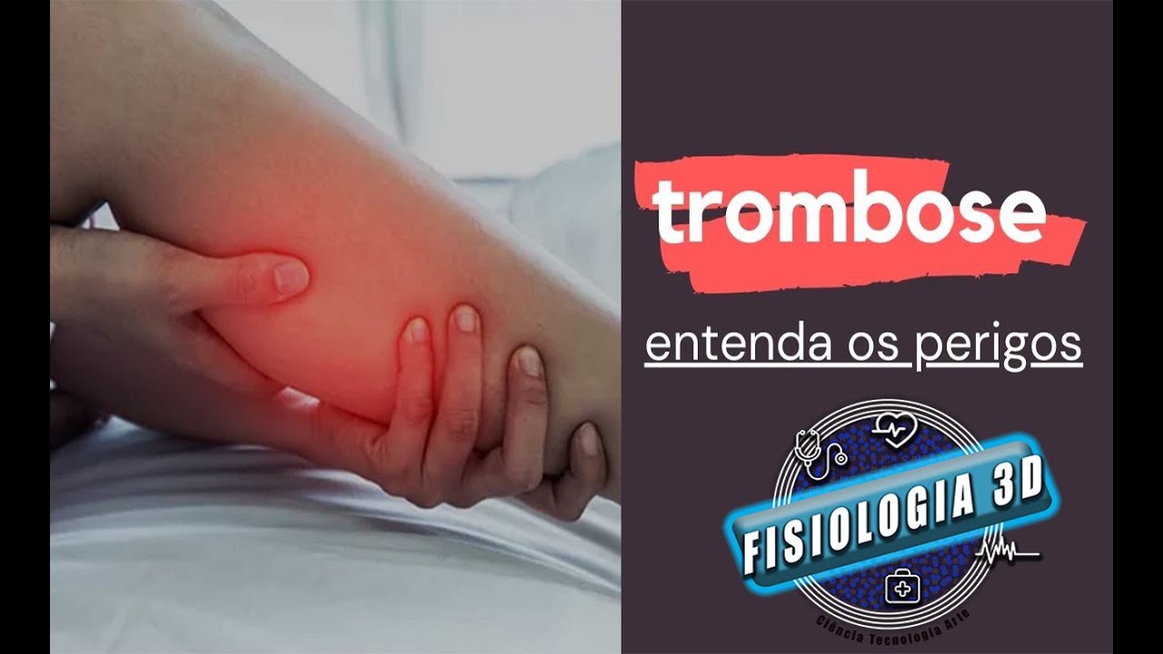 Trombose: Entenda os Sintomas e Como Ela Pode Ameaçar Sua Saúde