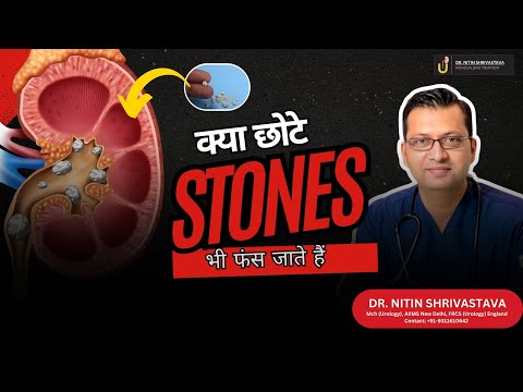 Small Kidney Stone But Stuck - Why Tiny Stones Can Still Block the Ureter