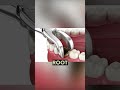 Cavities Explained | What Happens If You Ignore Tooth Decay?