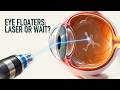 Eye Floaters: Laser, Surgery or Just Wait?