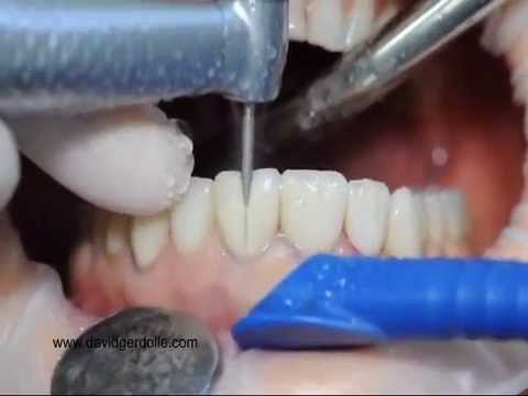 Procera Veneers Removal