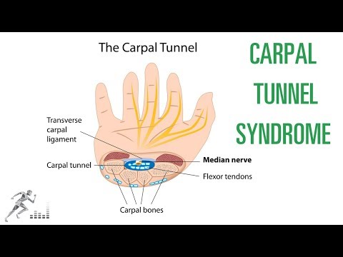 Carpal tunnel syndrome: Signs, symptoms and treatment options