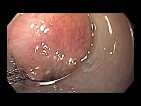 RME de un adenoma residual con cicatriz