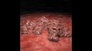 Stage 4 Cancer Here is How It Destroys The Body