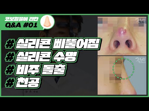 코 보형물에 관한 Q&A #01｜실리콘 이동, 수명, 돌출, 천공｜코성형 부작용