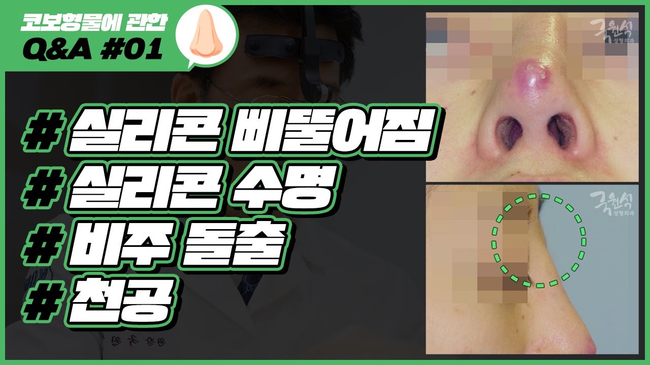 코 보형물에 관한 Q&A #01｜실리콘 이동, 수명, 돌출, 천공｜코성형 부작용 썸네일
