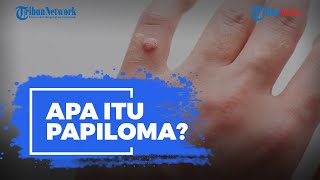 Apa Itu Papiloma? Kenali Gejala dan Penyebabnya
