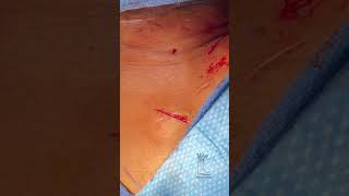 How to close a trocar/small surgical incision via an interrupted or a running subcuticular￼ stitch