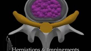 Prolapsed Disc Herniations and Impingements
