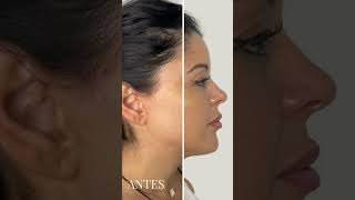 ANTES Y DESPUÉS DE UNA ARMONIZACIÓN FACIAL - Eva Garrigós Gracia