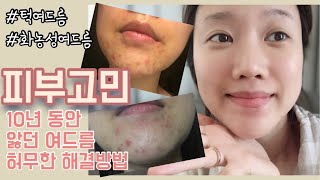 여드름 없애는 방법!ㅣ여드름관리,여드름고민,턱여드름,피부과가지마세요!