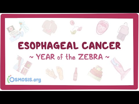 Esophageal Cancer (Year of the Zebra)