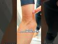 😱STUNG ! OUCH!🔥 Hot Shower vs. Bluebottle Sting! 😨 Will This REALLY Work?! 🇦🇺 #shorts